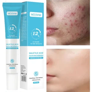 Creme para acne facial, remove espinhas