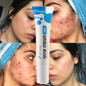 Creme para acne com 20% de ácido azelaico