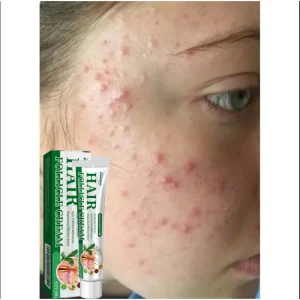 Creme antiacne que remove eficazmente nódulos