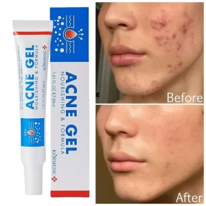 Creme eficaz para remoção de acne, repara vermelhidão