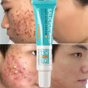 Creme facial com ácido salicílico para tratamento da acne