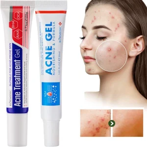 Creme para remoção de acne, reparador antiacne